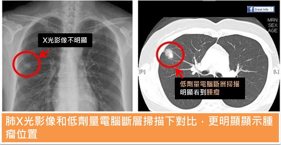 肺癌風險評估