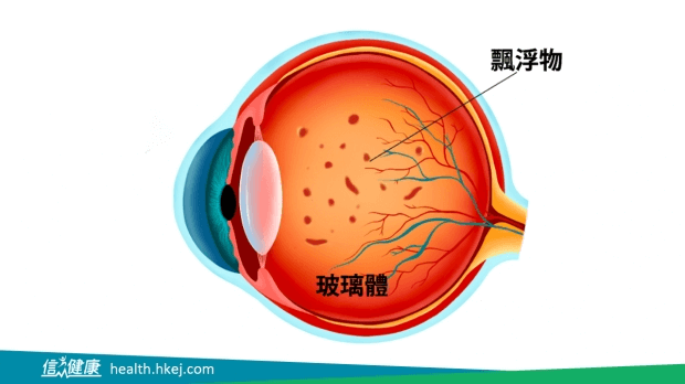 飛蚊症迷思